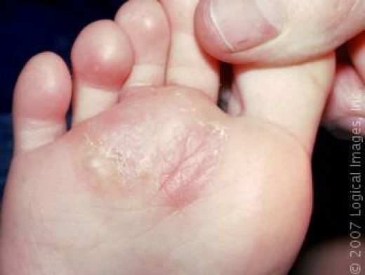 Image Gallery infected athletes foot pictures