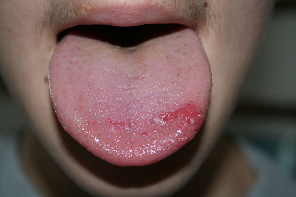 When should you see a doctor for the burning tongue disease?