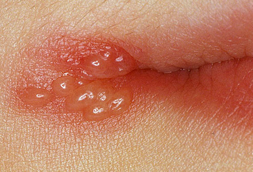 How To Get Rid Of Blisters On Face : Recognizing Genital Herpes