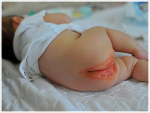 heat rash pictures. baby heat rash treatment. heat