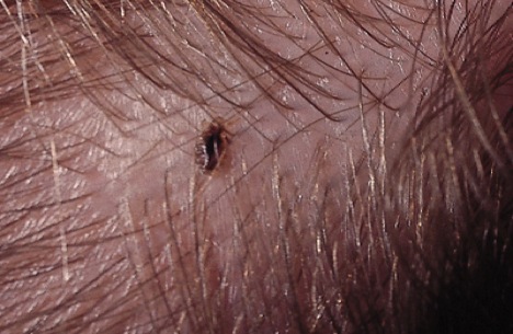 eyelashes lice