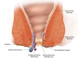 pictures of hemorrhoids