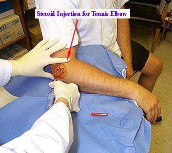 What kind of therapy do you need for tennis elbow?