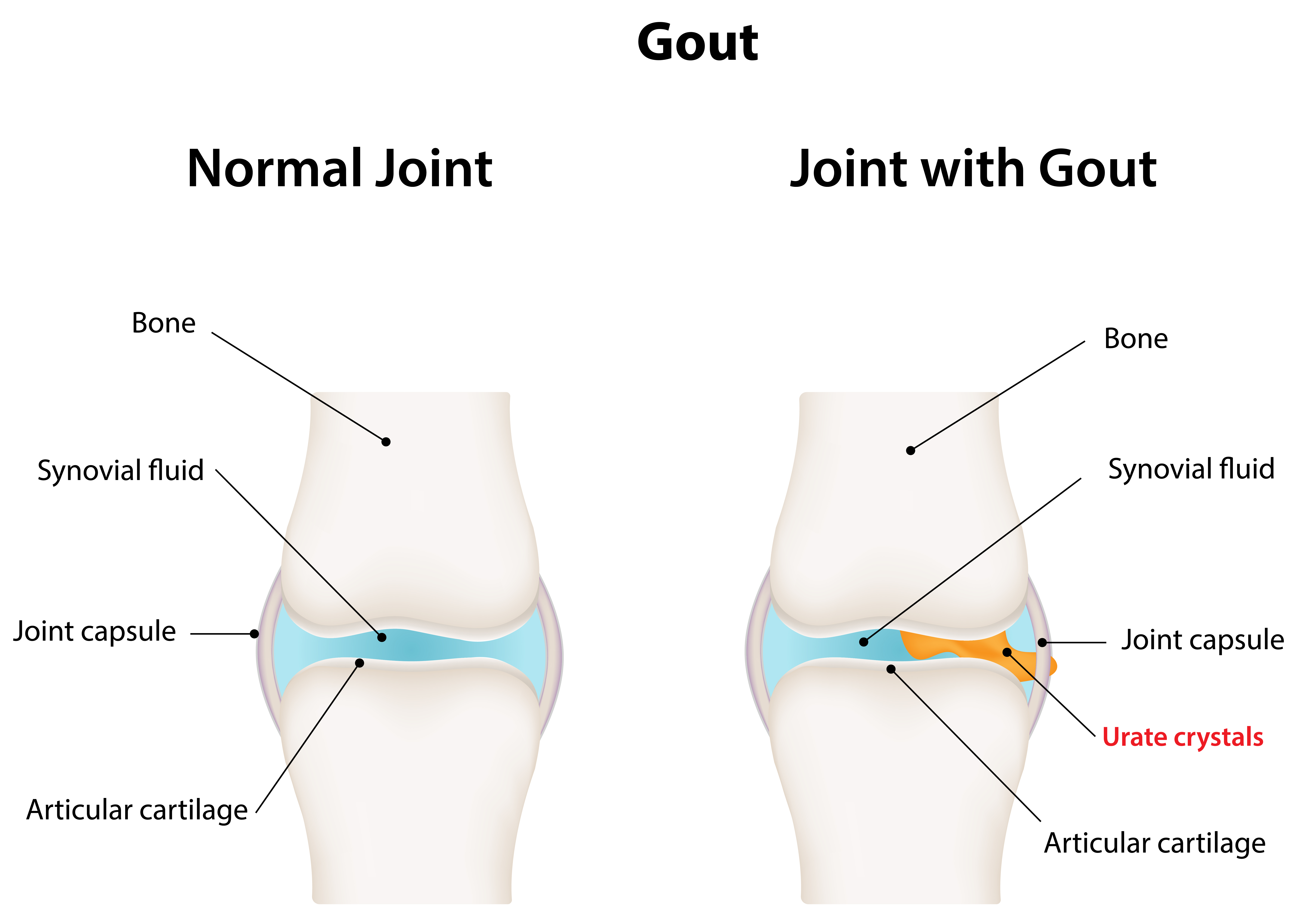 gout in women