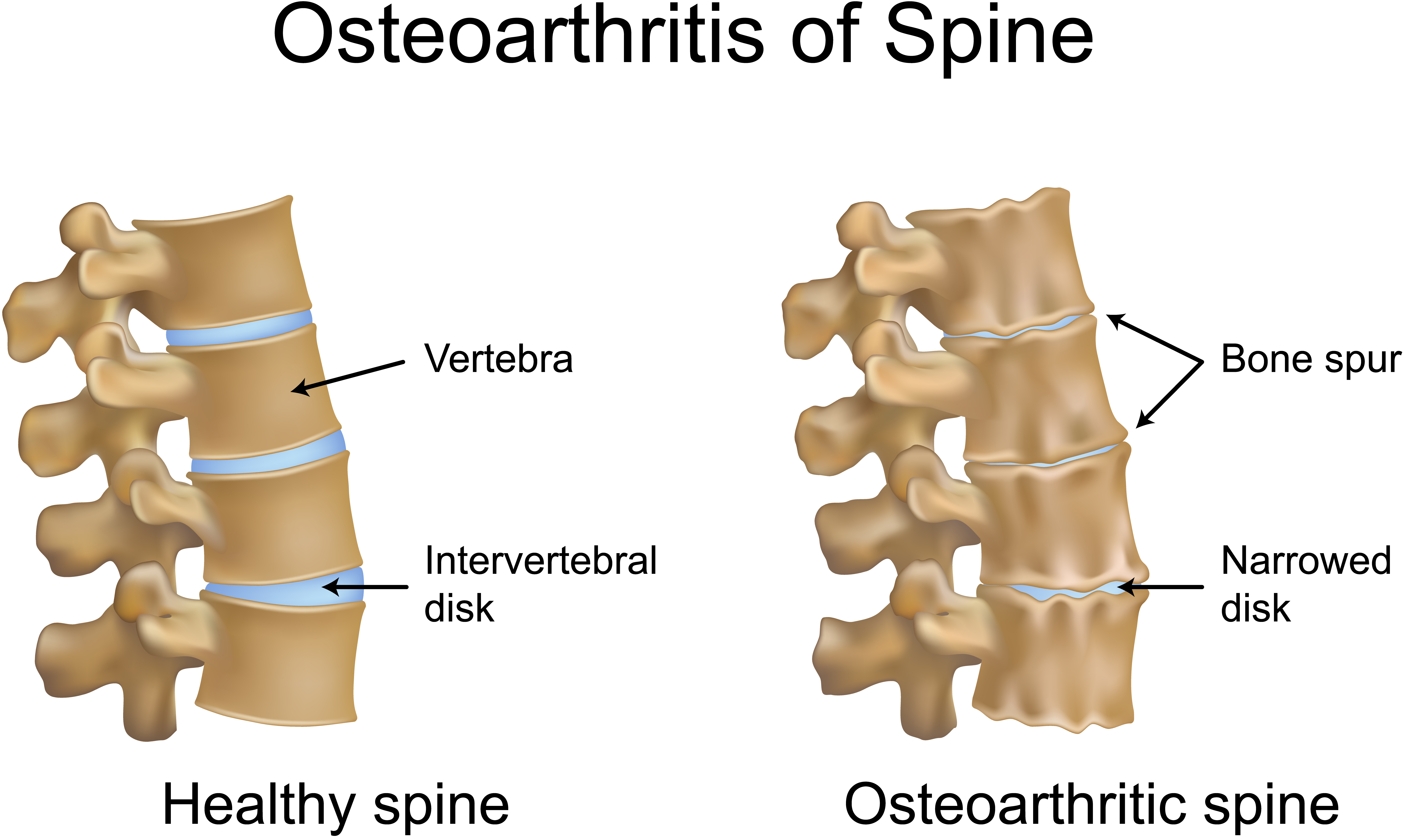 When should you seek treatment for an osteophyte?