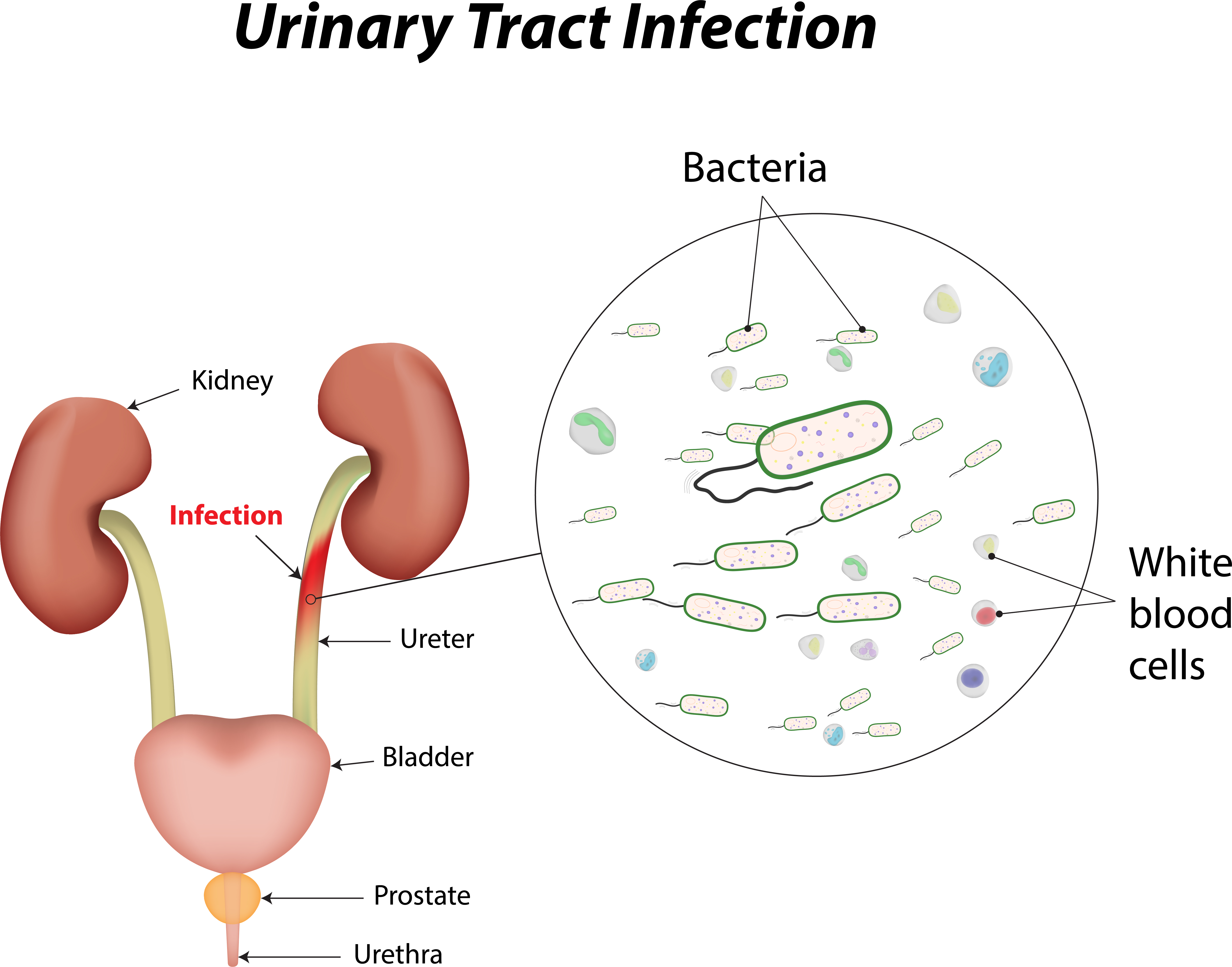 What does cranberry do for a bladder infection?