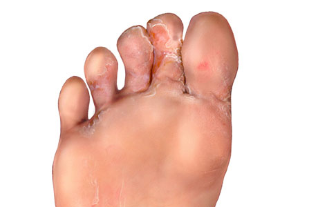 Risk Factors of Athlete’s foot