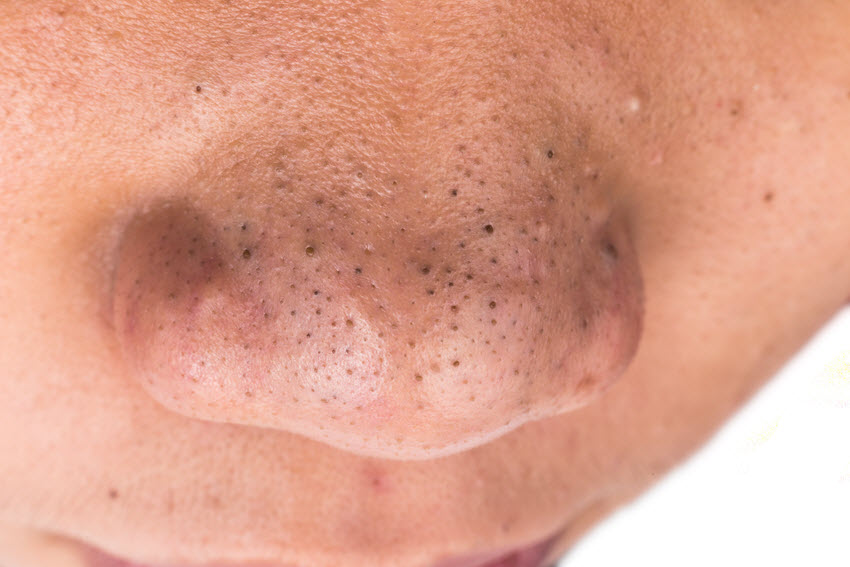 Blackheads on Man's Nose.