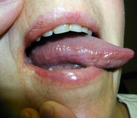 Burned Mouth Syndrome Treatment