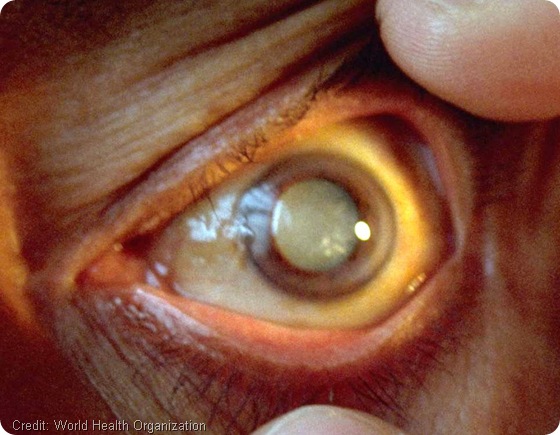 What are Cataracts?