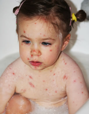 Natural Chicken Pox Remedies