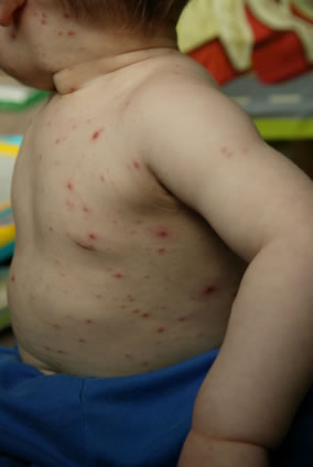 Chicken Pox Treatment