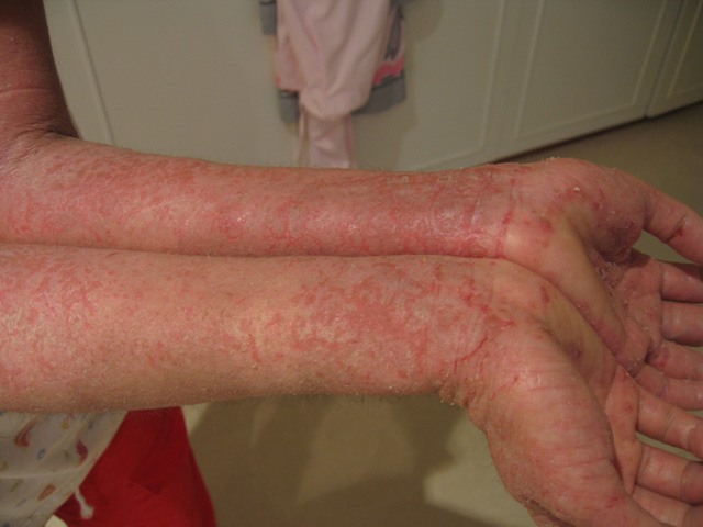 Eczema Information