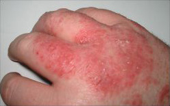 Preventing Eczema