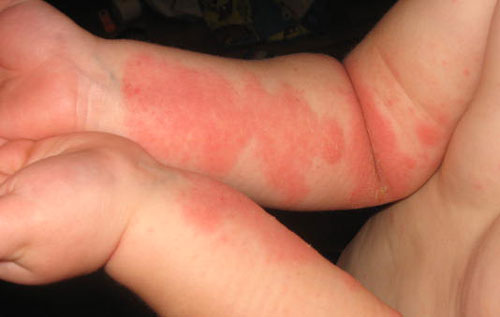 Eczema Prevention Techniques