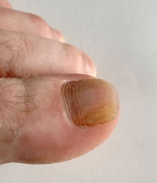 Fungal Infections