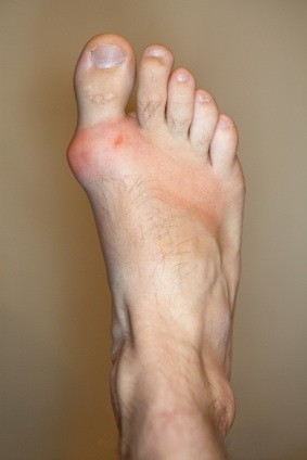 Gout from Uric Acid