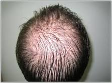 Hair Loss Symptoms