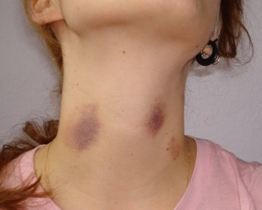 Pictures of Hickeys on a Girl's Neck, by Janek B.