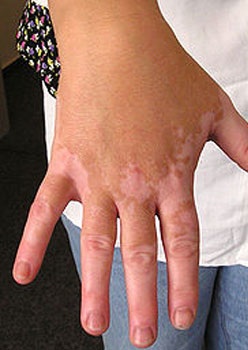 Symptoms of Leucoderma