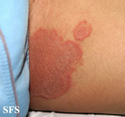 Lyme Disease Rash