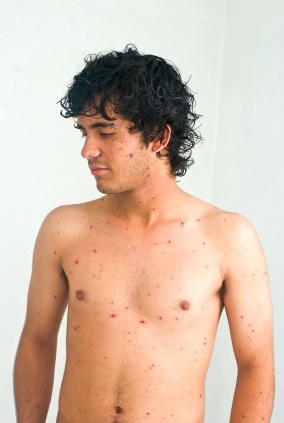 Measles Symptoms