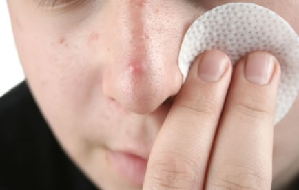 Herbal Pimple Treatment