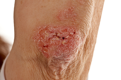 Effects of Psoriasis