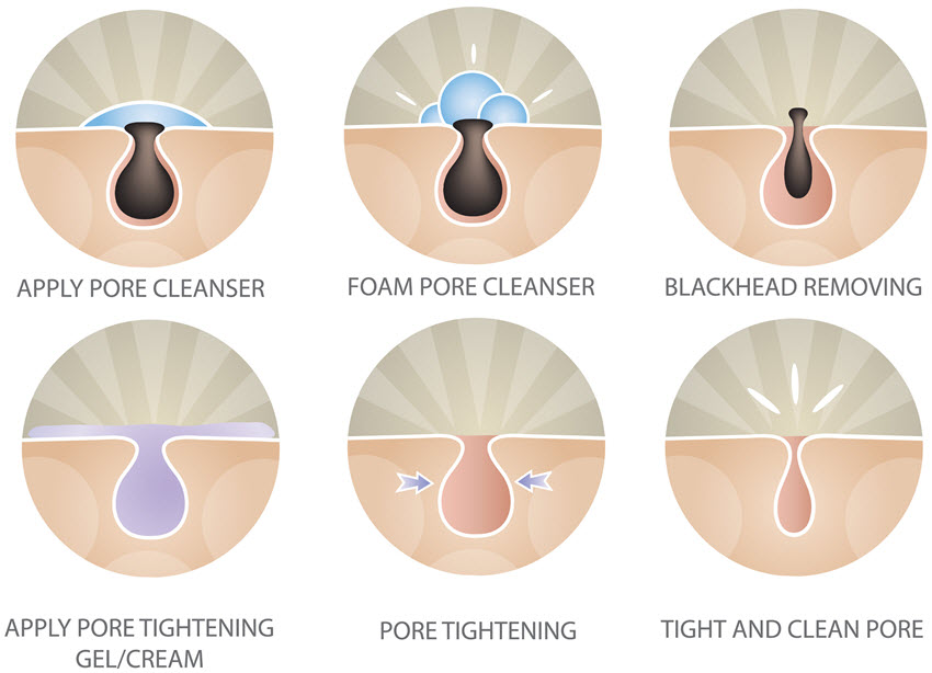 Blackhead extraction process.