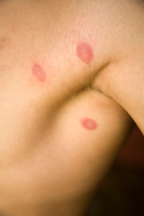 Ringworm Symptoms