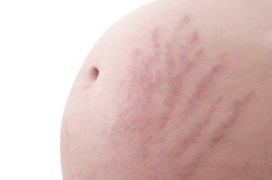 Stretch Marks from Pregnancy
