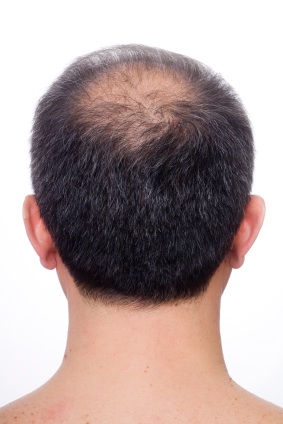 Thinning Hair Prevention 