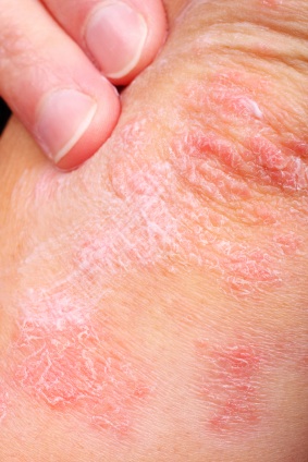 Tinea Versicolor Images