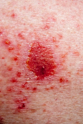 Symptoms of Tinea Versicolor