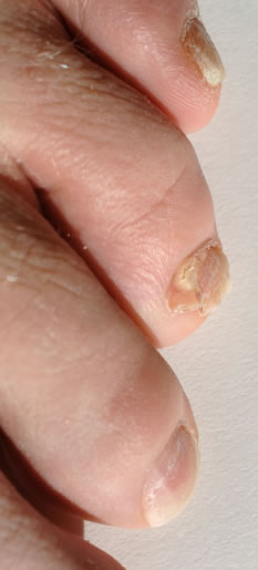 What Does Toe Nail Fungus Look Like