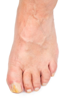 Toe Nail Fungus Natural Remedies