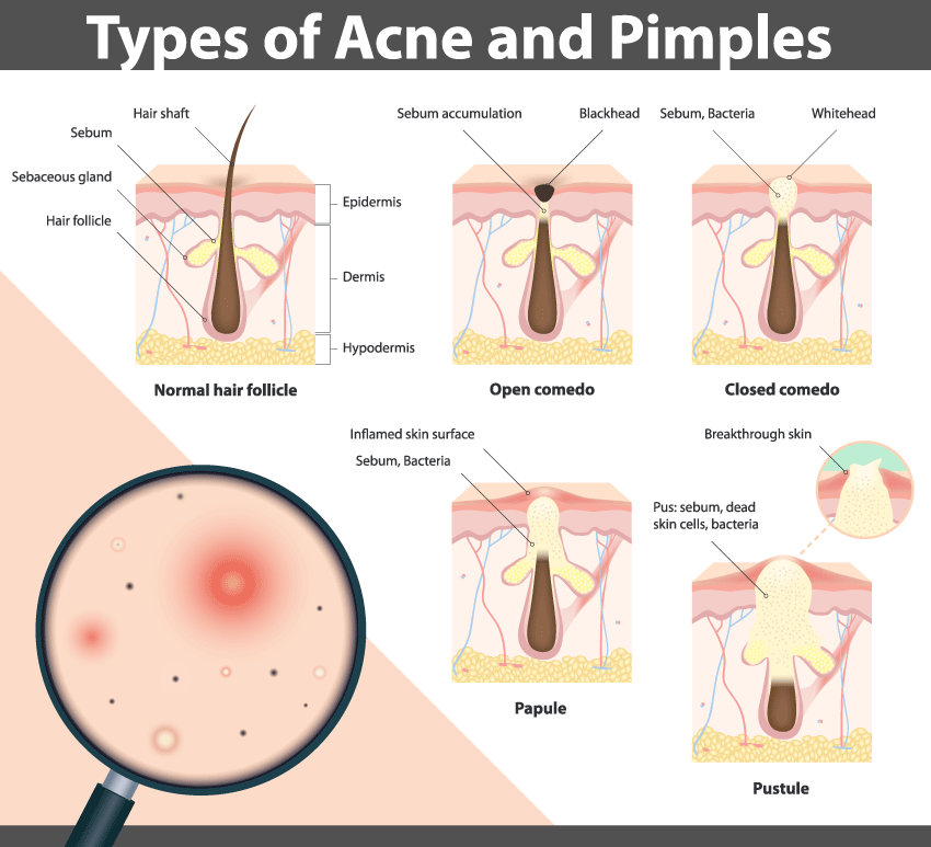 Illustration of Types of Acne & Pimples, including Whiteheads & Blackheads.