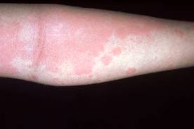 Angiodema and latex allergies