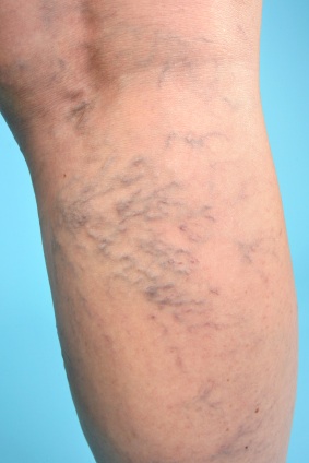 Treatment for Varicose Veins