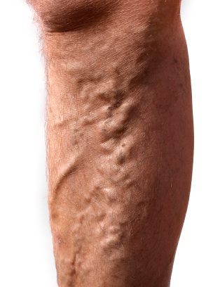 Varicose Vein Symptoms