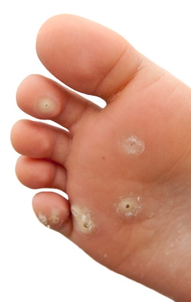 Wart Treatment