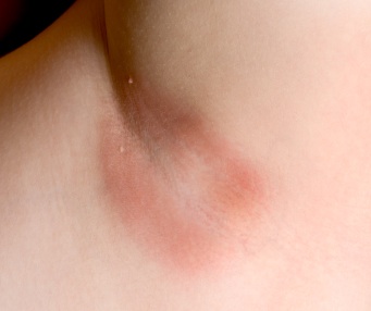 Armpit Yeast Infection