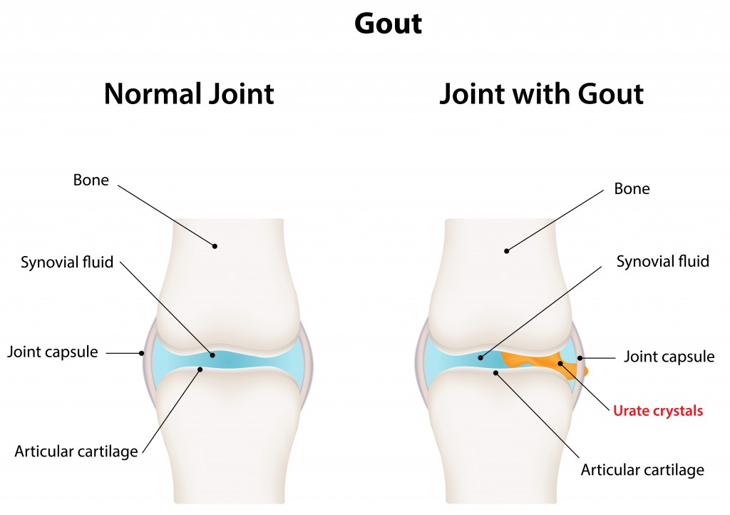 Gout.