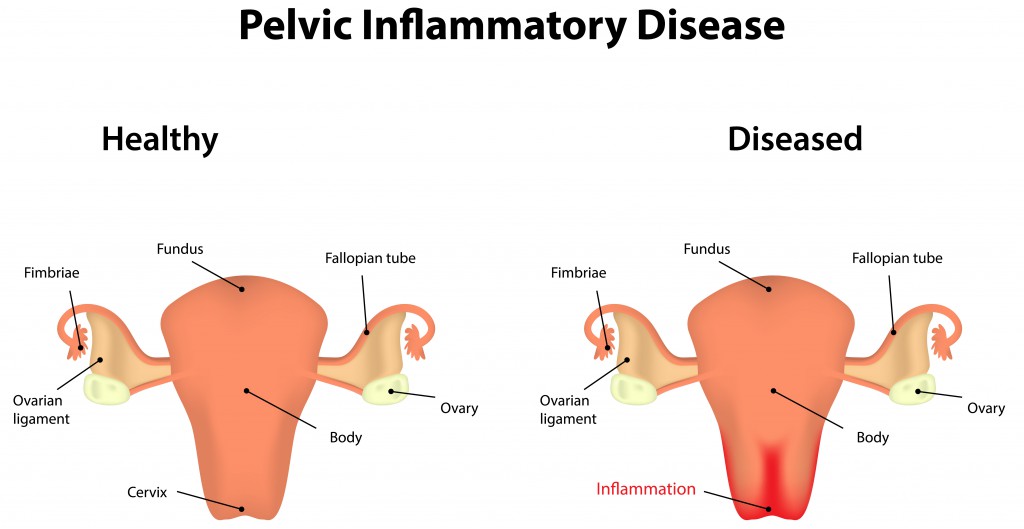 Pelvic Inflammatory Disease.