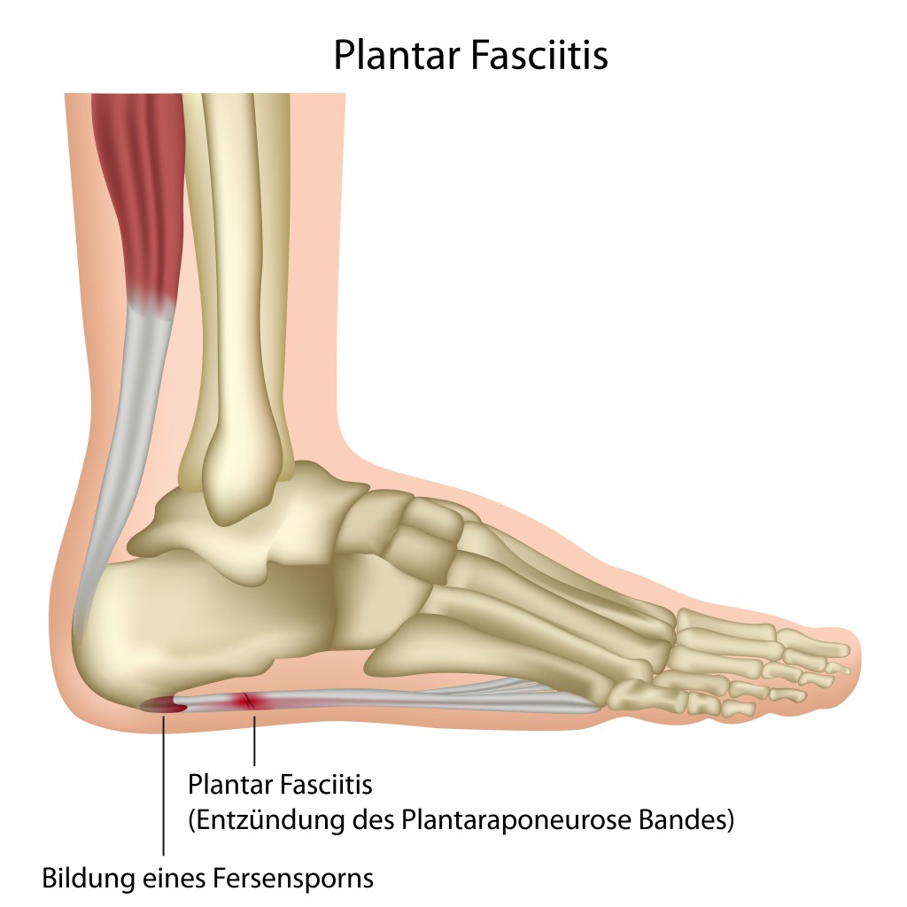 Plantar Fasciitis.